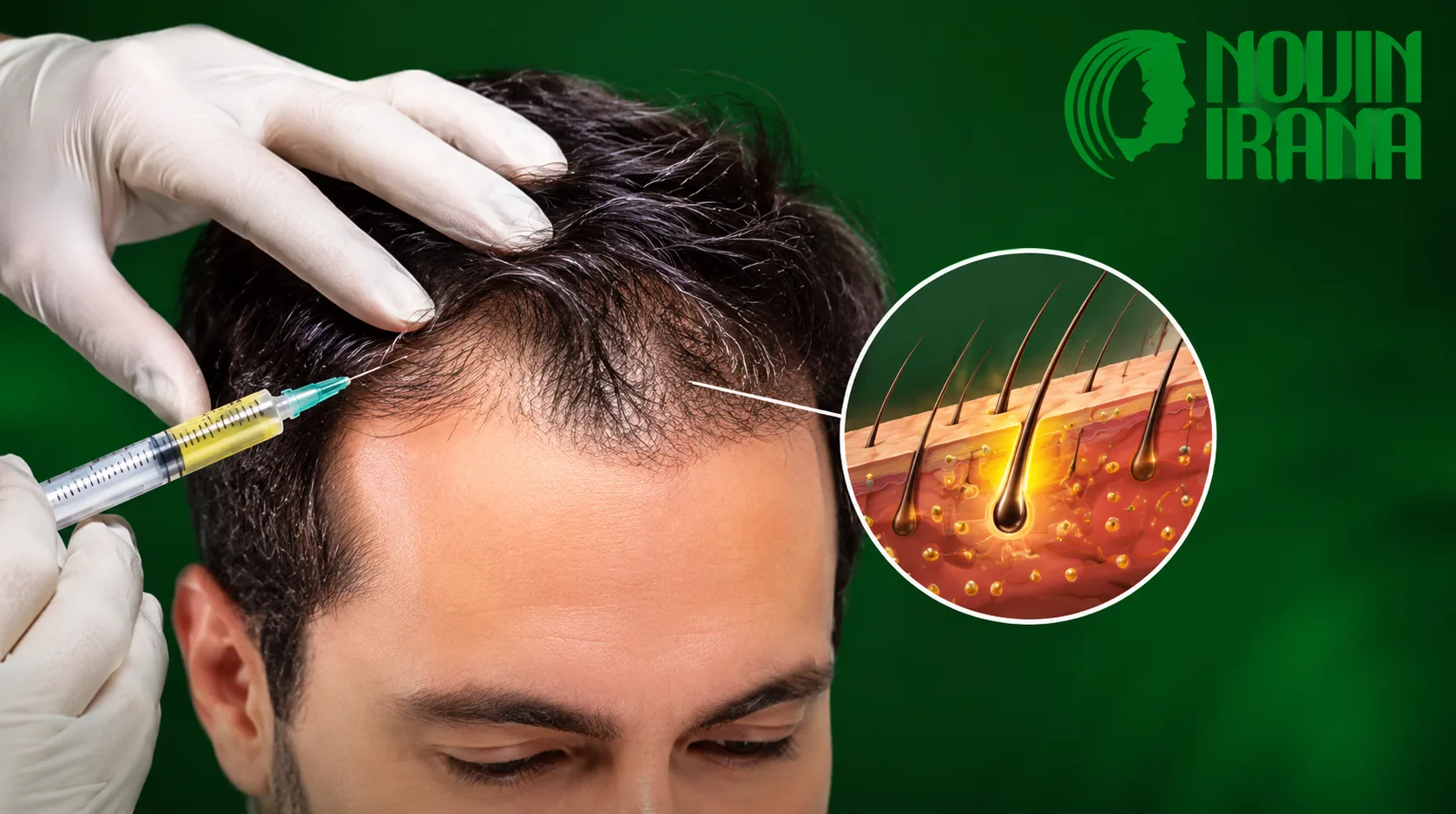 مزوتراپی برای چه نوع ریزش مویی مناسب است؟